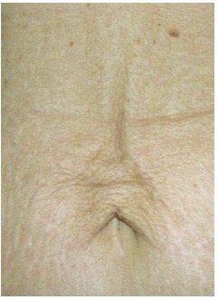 Skin Tightening Before Treatment